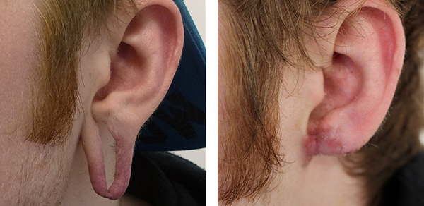 Ear lobe repair surgery is done to fix earlobes that have been torn or split. Get advanced Earlobe repair treatment in Bangalore by an experienced surgeon in Hairline clinic Bangalore. 